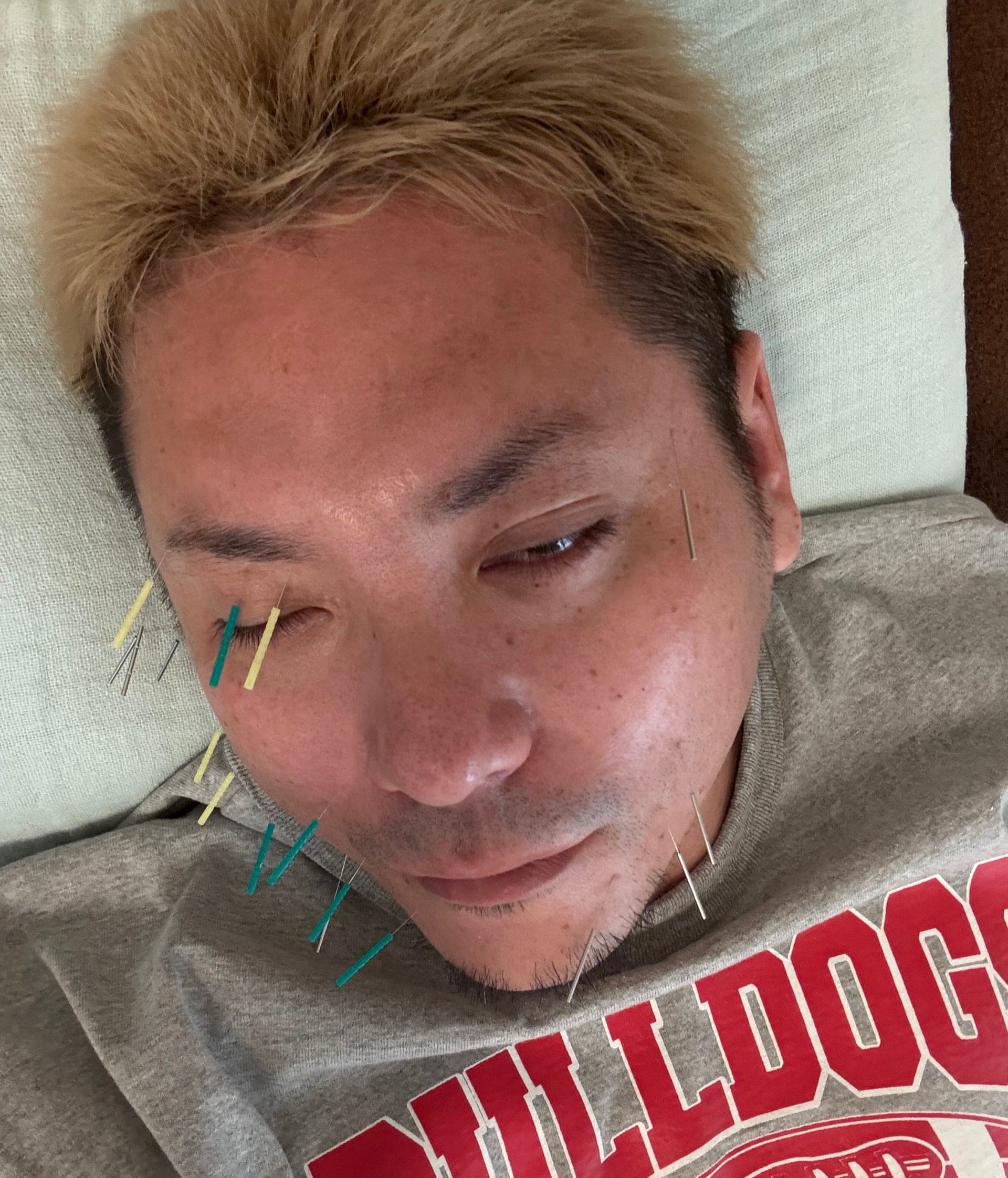 毎日、1時間の針治療を行う