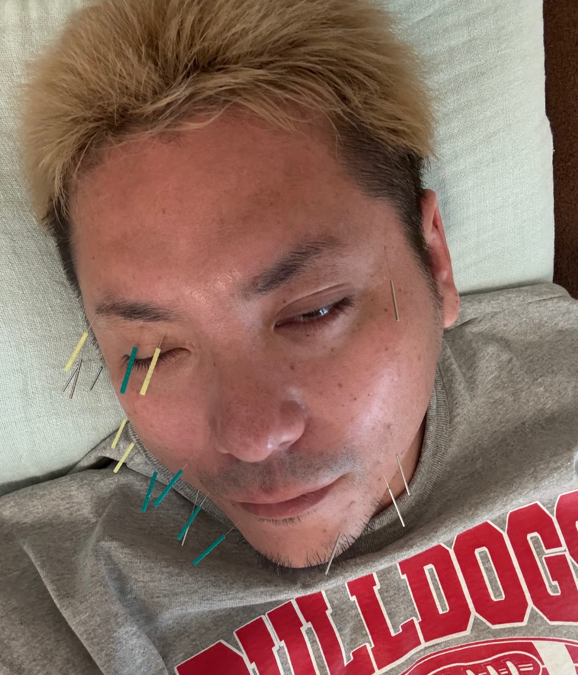 毎日、1時間の針治療を行う